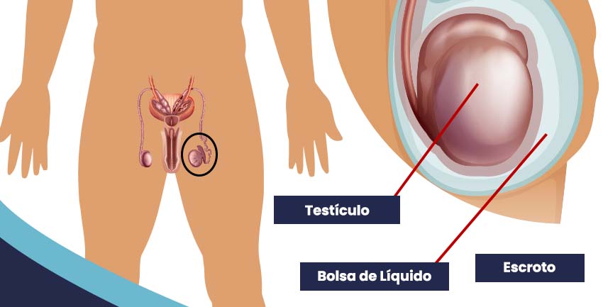 Você sabe o que é a hidrocele?