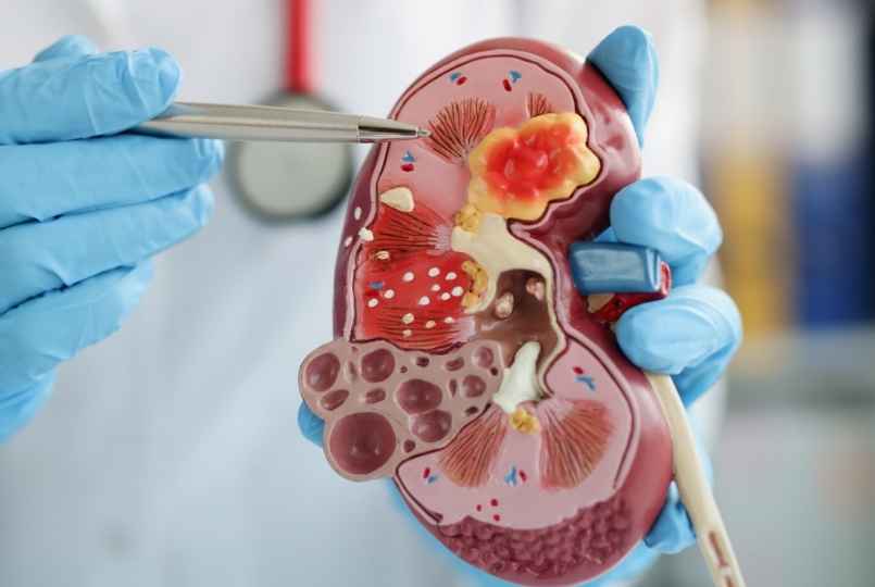 Cálculo Renal (Pedras nos Rins)