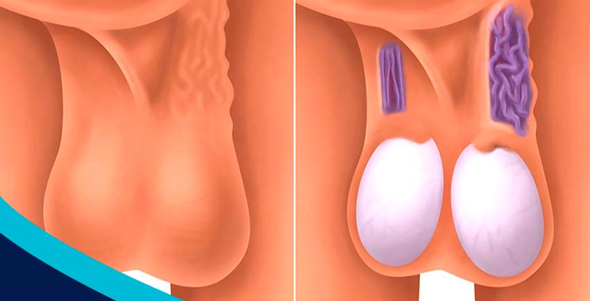 Varicocele: o que é, sintomas, tratamento e complicações