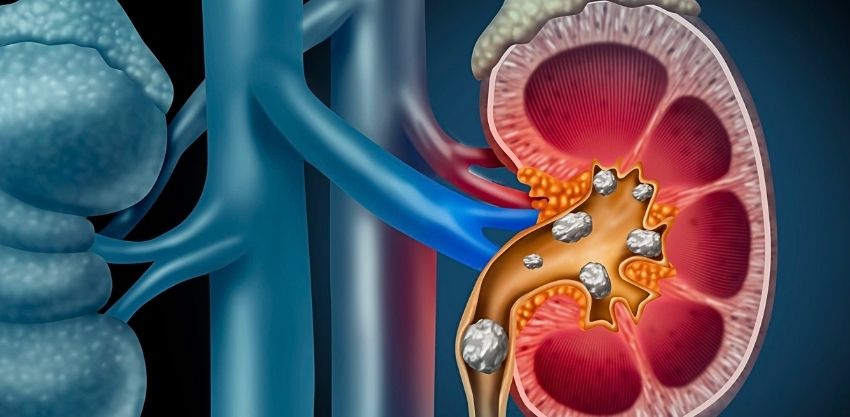 Previna os Cálculos Renais com Hábitos Simples