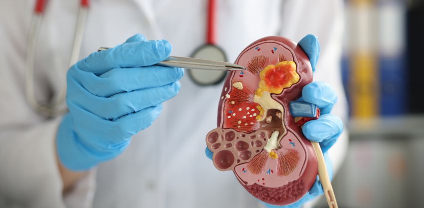 Pedras nos rins: você sabe como se formam?