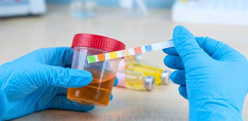Sangue na urina nunca é normal: entenda o que pode ser e como investigar a hematúria